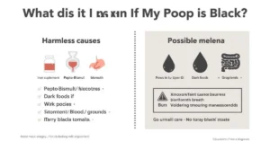 Infographic comparing harmless black stool causes vs melena warning signs